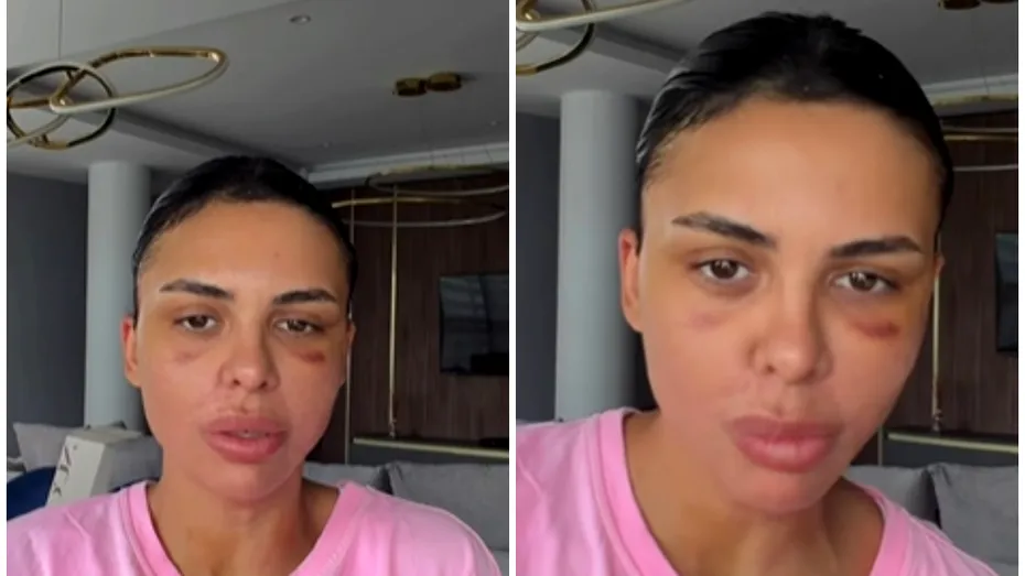 Andreea Popescu, transformare după ce a slăbit 20 de kilograme. Ce operații estetice și-a făcut și cum a decurs recuperarea